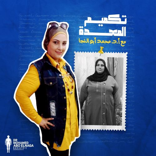 نظام الاكل بعد التكميم